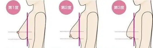 乳房下垂矫正的手术方式有哪些?