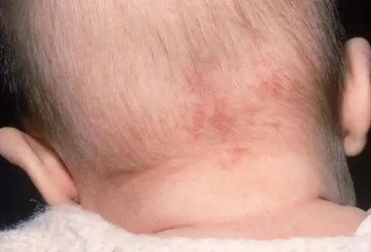 新生儿红斑:新生儿红斑,又被称之为"鲑鱼斑",是新生儿常见的血管性