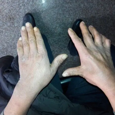 肌肉萎缩(右手第一骨间肌)