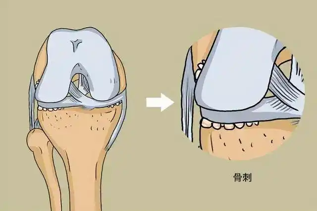 骨刺不是病,反而是对身体的一种保护?那为什么这么疼_腾讯新闻