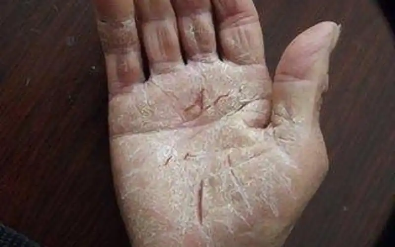 手掌干裂怎么办?这三个妙招百试不爽,轻松搞定!