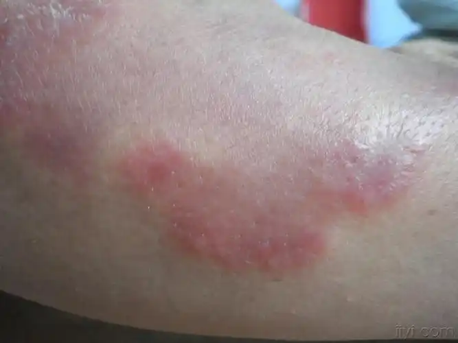 离心性环状红斑