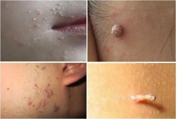 女性尖锐湿疣真实图 (31)_有来医生