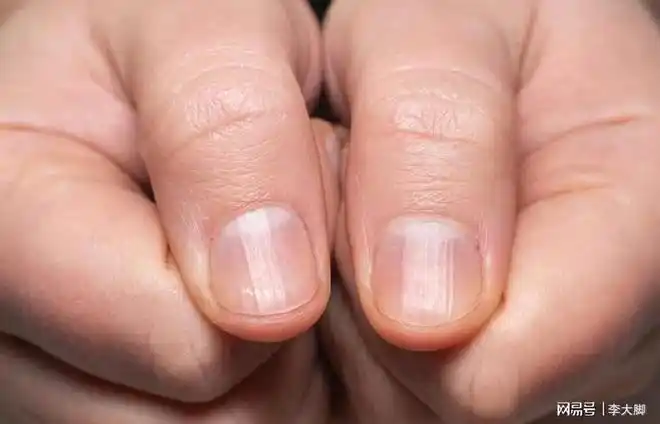提醒:指甲若出现4种症状,需留心观察_网易订阅