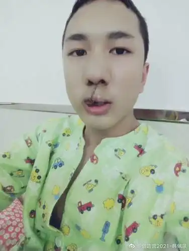 韩美娟晒唇腭裂时期照片呼吁大家给予患者温暖