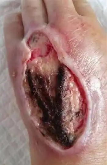 一例输液外渗致皮肤坏死的救治体会(满满干货,医护必读)