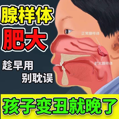 腺样体肥大贴矫正儿童张嘴呼吸睡觉打呼噜小儿鼻塞鼻涕面容 单盒不太