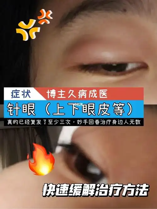 97针眼经历:16615第一次是在2020年冬,98眼睛不舒服,立马去了