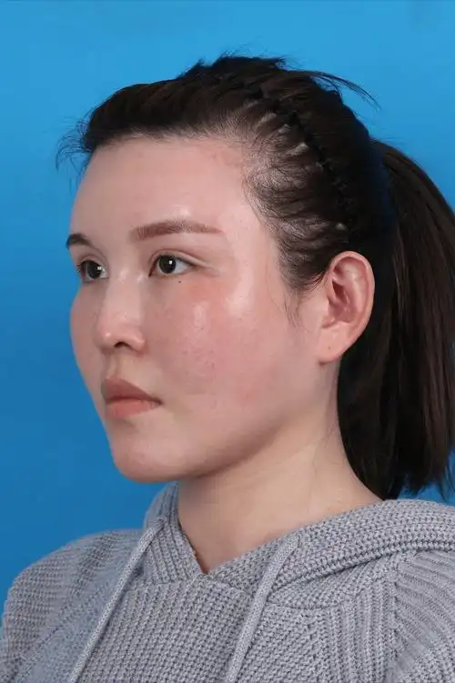 一名不喜欢"鼻梁塌"的30岁女孩来到北京整容,一个月后,结果揭晓_鼻子