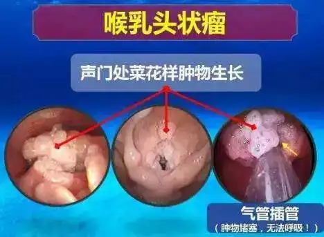 (4)进行喉镜检查,可见淡红或暗红色,表面不平,呈乳头状的肿瘤,多基底