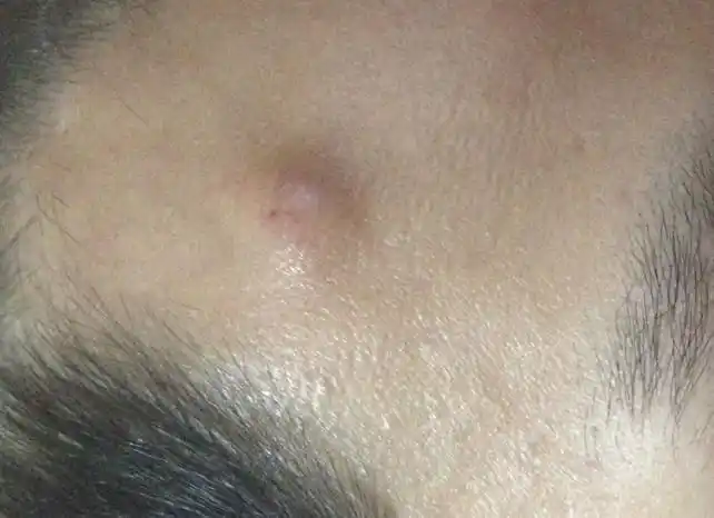 请教暗疮与痤疮的问题