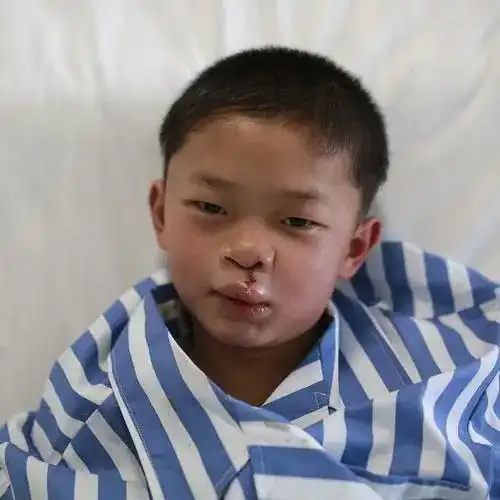 唇腭裂图片引起唇腭裂的原因有哪些