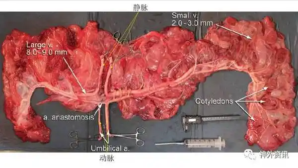 巧用人胎盘和牛胎盘血管进行显微血管吻合技术训练