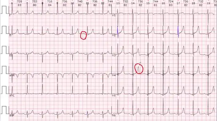 心电图不会看靠这5步就够了