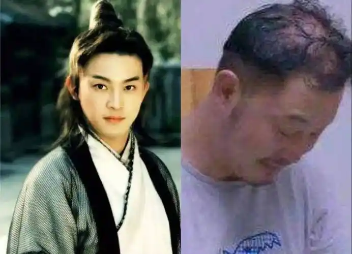 脱发困扰,胡歌发际线堪比吴彦祖,何炅头发稀疏能见头皮_假发_沙溢