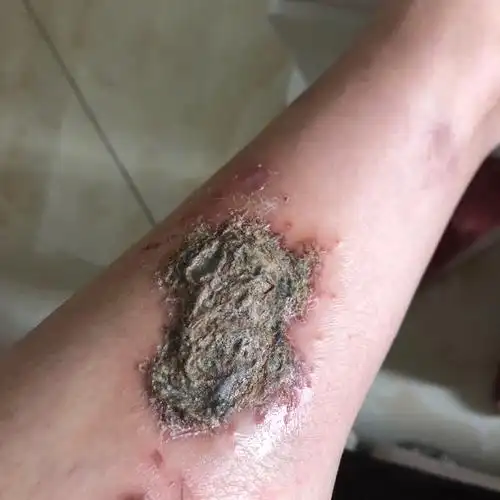 真的不知道这是怎么回事?就前段时间有点弄破了 然后结痂就是这样了