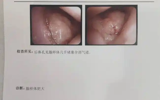 打呼噜就是腺样体肥大吗?有药可用吗?