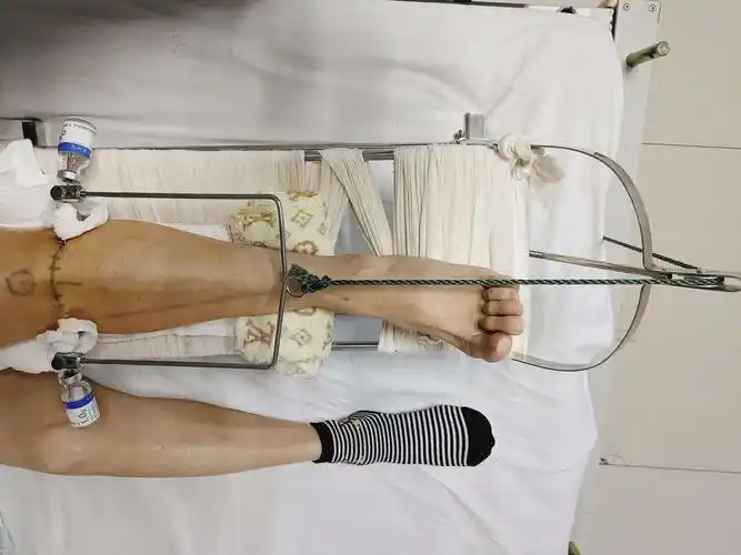 这在专业术语上叫做"牵引",常见的牵引有骨