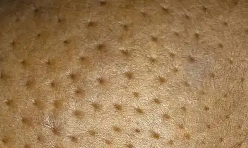 牵拉相应部位的皮肤,出现"酒窝征",即乳腺皮肤出现一个小凹陷,像小