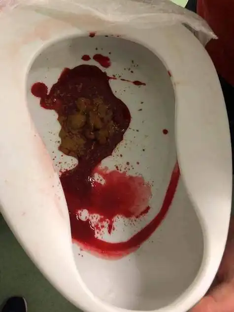 肠胃炎的症状便血,肠胃炎的症状便血怎么办大家好,今天小编关注到一个