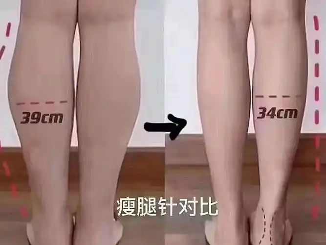 夏季必打的针剂之一瘦腿针05