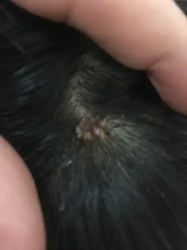 我儿子今年13岁前几天发现头上长了一个像菜花一样