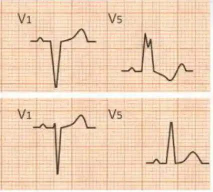 完全性左束支传导阻滞心电图特征有哪些?