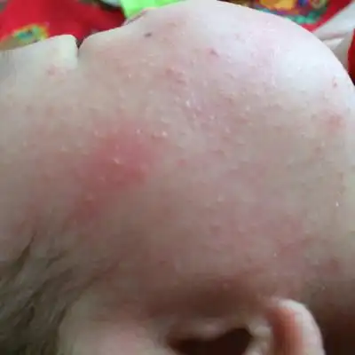 脸上起了一些小疙瘩,大家帮看看这是热疙瘩还是湿疹啊?怎麼办?谢谢