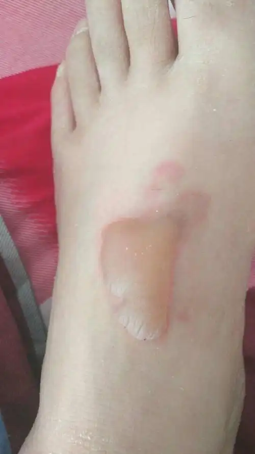 脚被蒸汽烫伤,起水泡,4天了,水泡还在,能不能挑破,会感染吗?