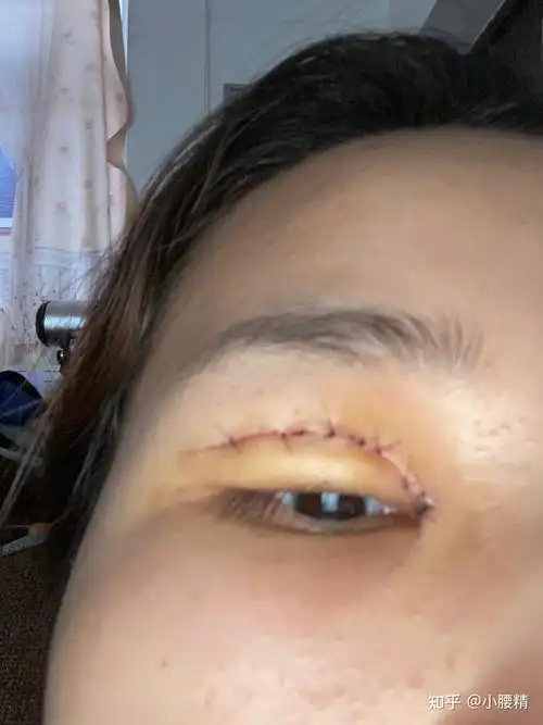 割完双眼皮第4天