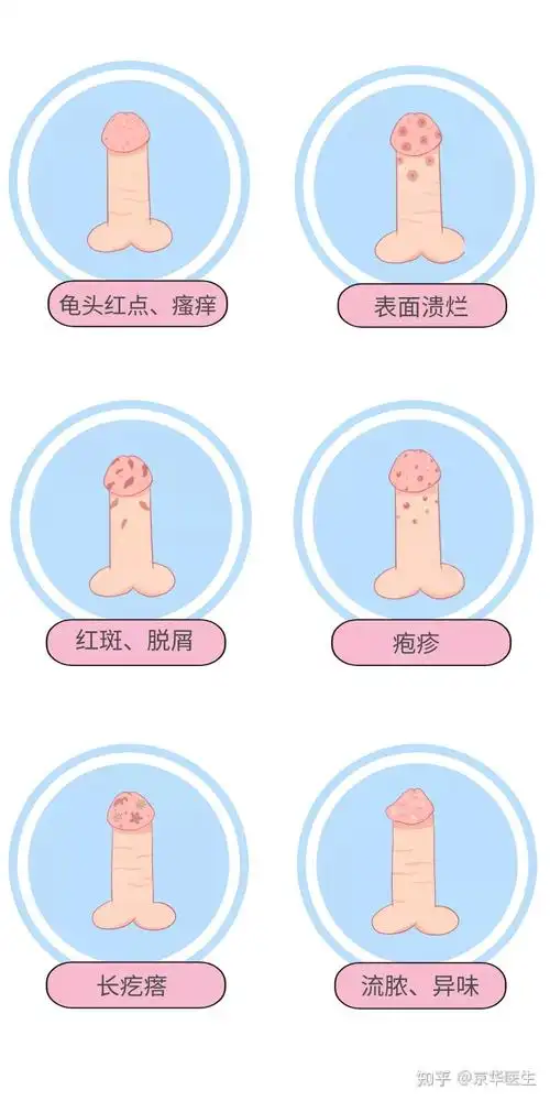 为何男性夏季易感染包皮龟头炎? - 知乎