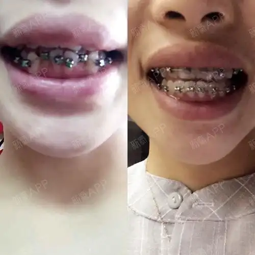 做牙齿整形的价格