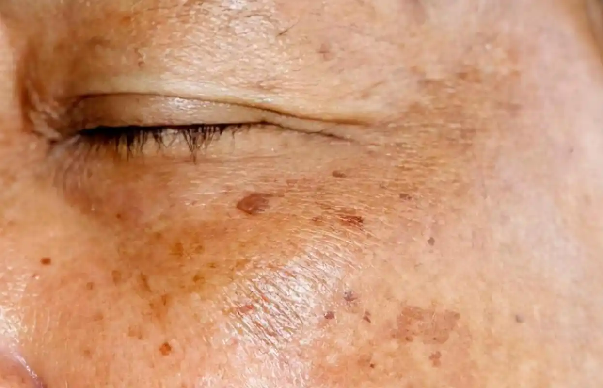 老年斑是什么样的老年斑的形成原因和治疗方法