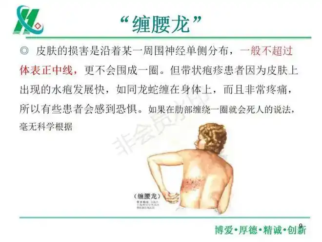 ppt带状疱疹的护理