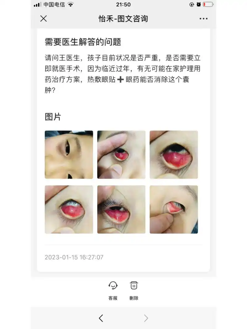 超大睑板腺囊肿(不用药就能消)  睑板腺囊肿,据说多发于青少年儿童