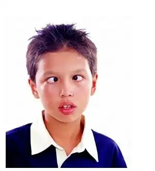 小儿斜视治疗要早 严重可造成心理阴影