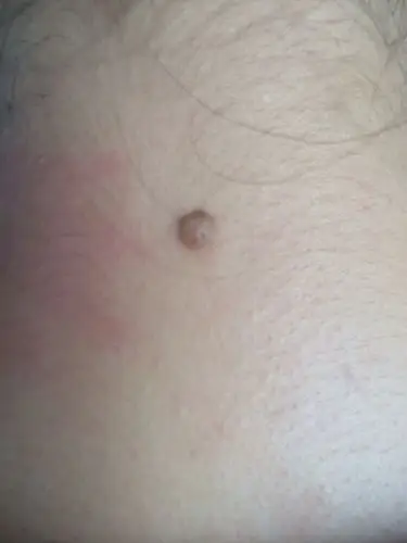 各位大师,我脖子后面正中央有颗痣,有人说是瘊子,有人说是苦情痣,而且