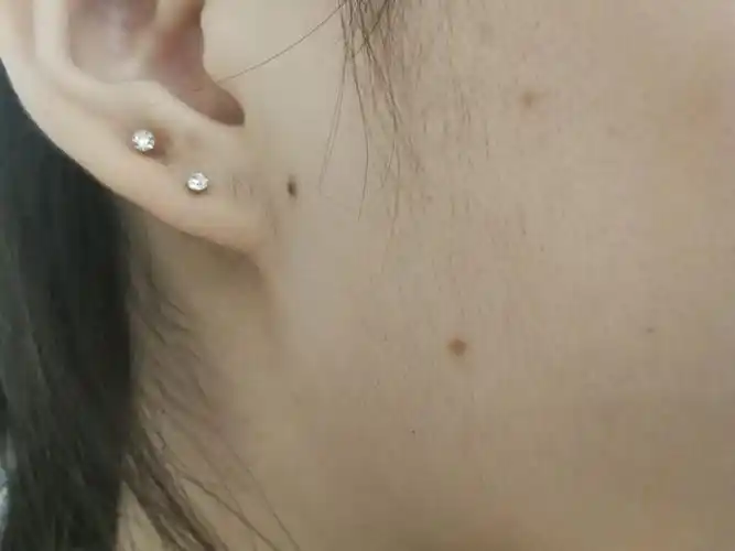 谁知道这三个痣是有什么意思吗! 还连成等边三角形了 能不能祛掉啊