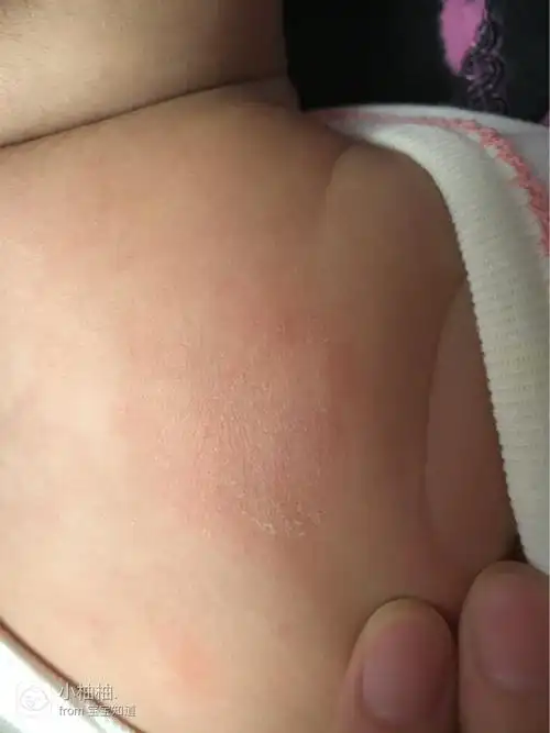 宝妈们帮忙看下宝宝背上起的是什么?摸的湿疹膏不管用,像是藓一样