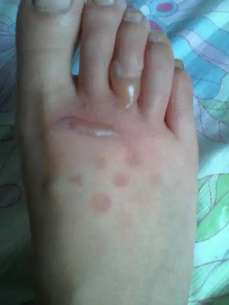 前天被开水把脚烫了,刚开始没起泡,我一直摸着依诺沙星乳膏,可这两天