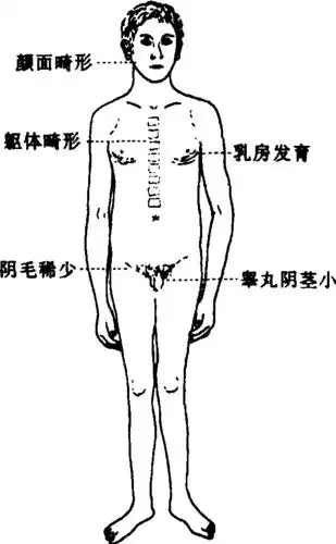 先天性睾丸发育不全综合征又称原发小睾丸症,或47,xxy综合征,即患者