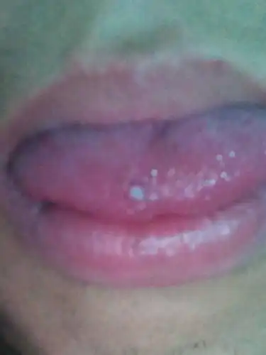 舌尖上起一个白泡,不痛,这是什么情况?