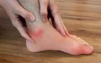 年轻人可能得痛风吗?年轻人患痛风的重要因素