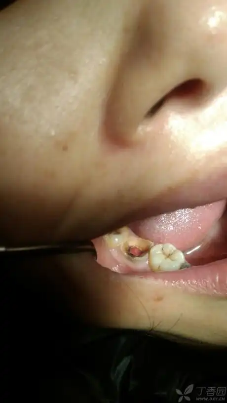 这个是慢性增生性牙髓炎吗?应有何处理? [病例帖]