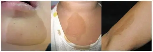 这种斑宝宝身上超过6个就得注意了