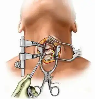 单纯神经根型颈椎病手术治疗的临床疗效和安全性