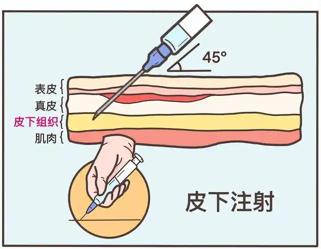 皮下注射是将少量药液注入皮下组织.