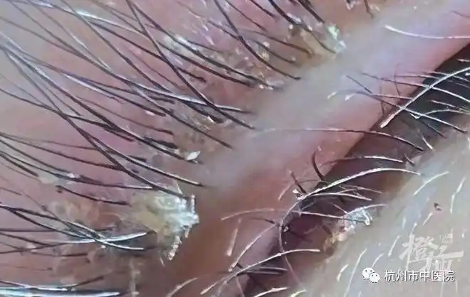 阴虱|假睫毛|寄生虫_网易订阅