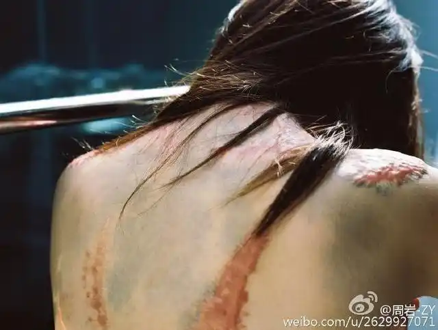 被富二代同学泼汽油烧伤的女孩拍写真 获网友大赞