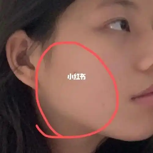 怎么能够改善侧脸宽大